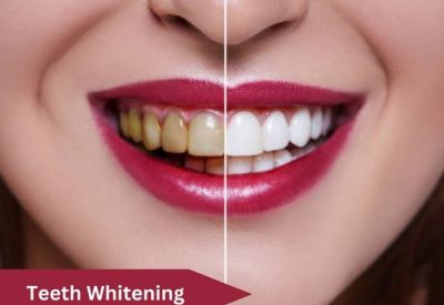 Teeth Whitening