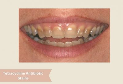 Tetracycline Antibiotic Stains